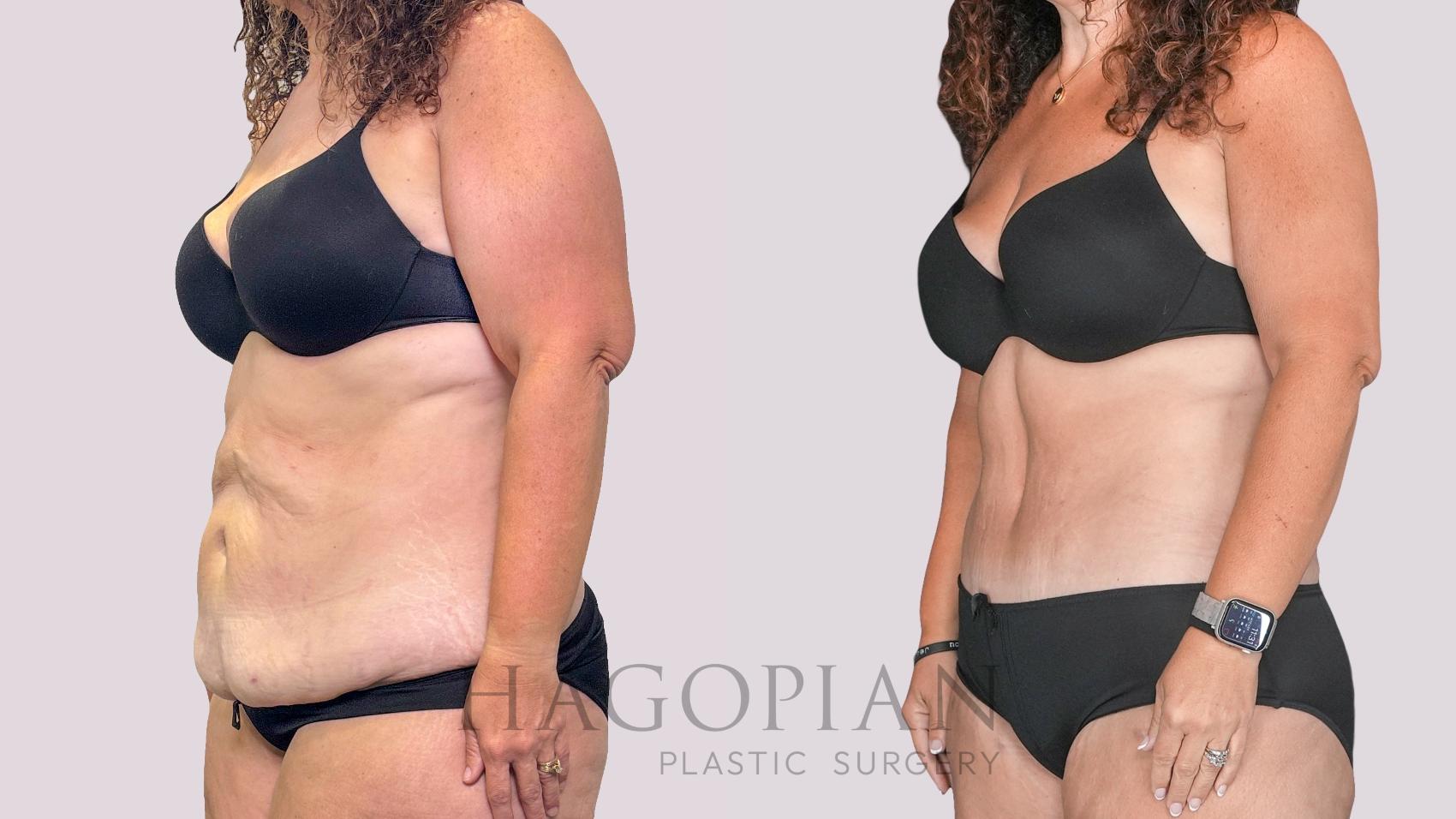 Before & After Drainless Tummy Tuck Case 279 Left Oblique View in Atlanta, GA