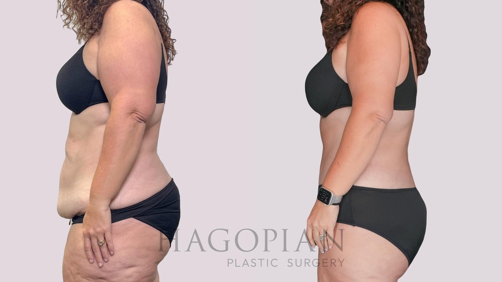 Before & After Drainless Tummy Tuck Case 279 Left Side View in Atlanta, GA