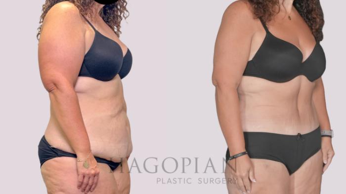 Before & After Drainless Tummy Tuck Case 279 Right Oblique View in Atlanta, GA