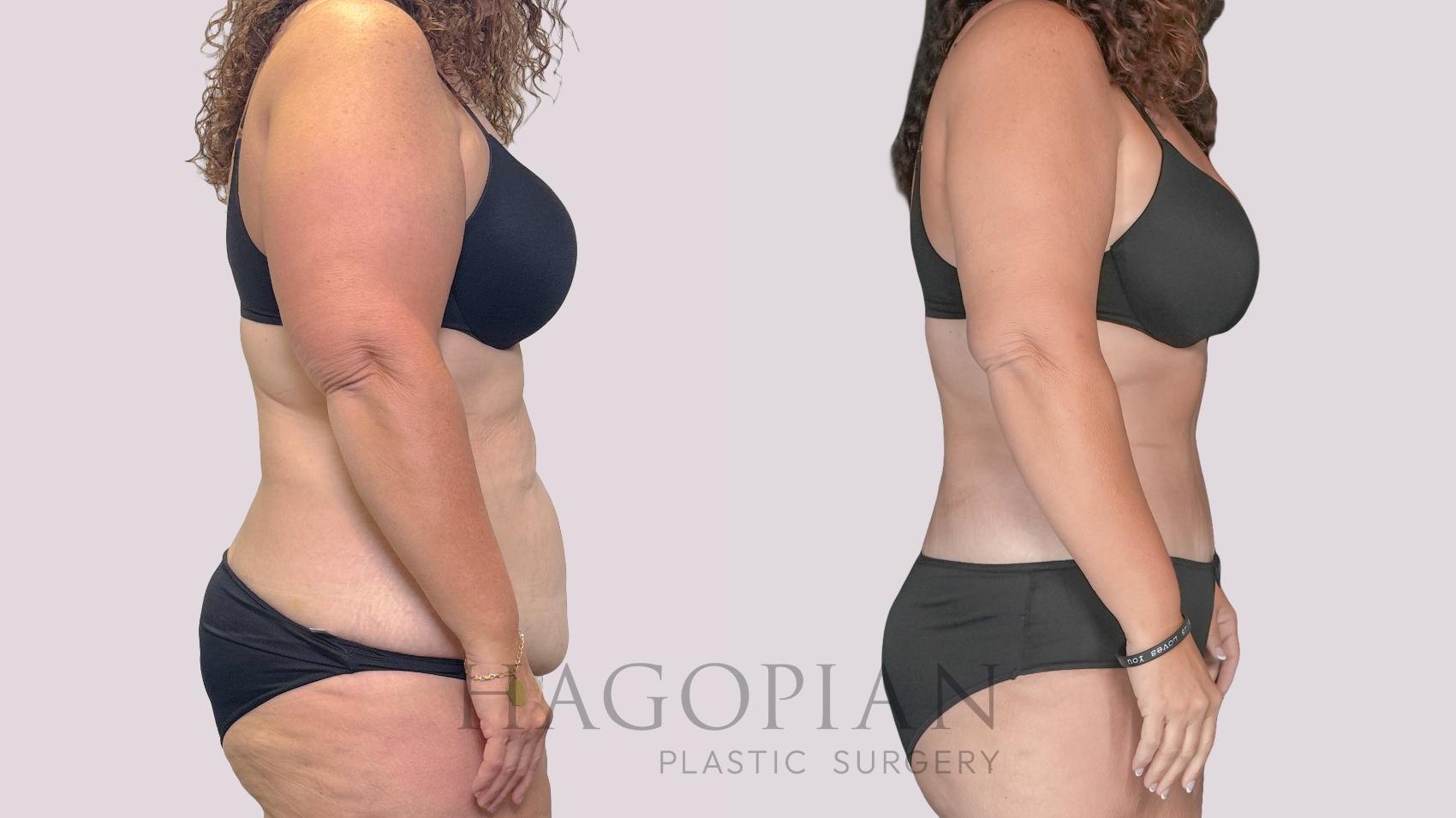 Before & After Drainless Tummy Tuck Case 279 Right Side View in Atlanta, GA