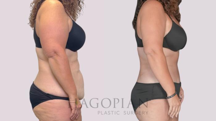 Before & After Drainless Tummy Tuck Case 279 Right Side View in Atlanta, GA
