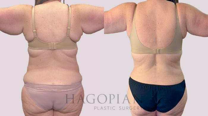 Before & After Drainless Tummy Tuck Case 291 Back View in Atlanta, GA