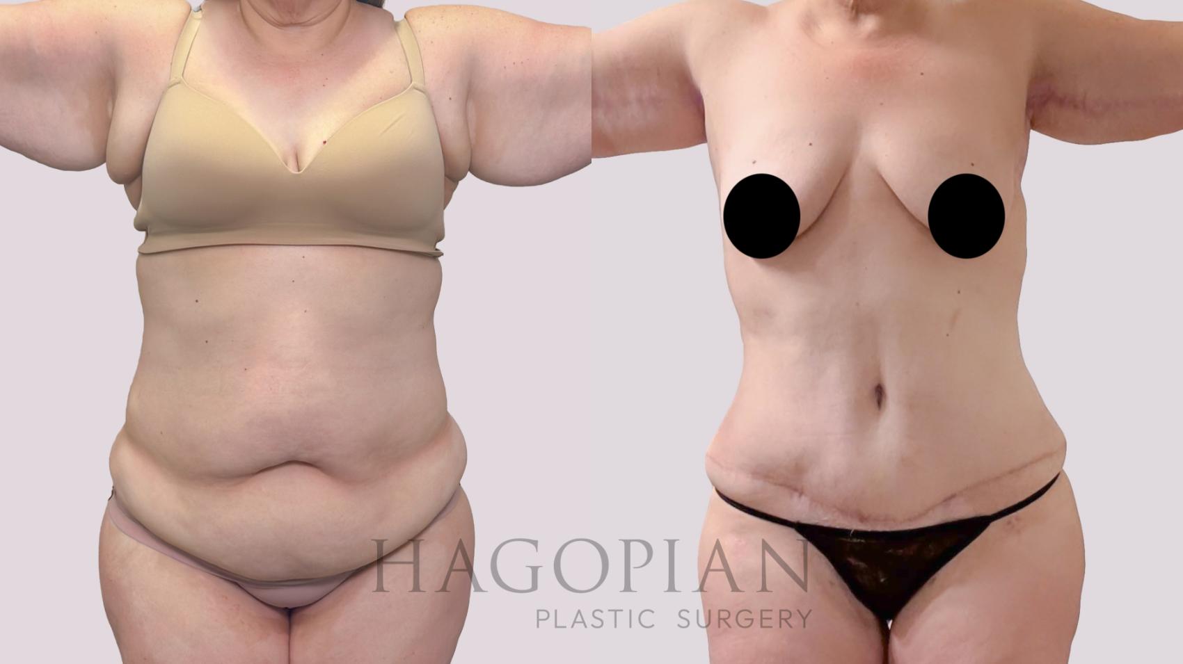 Before & After Drainless Tummy Tuck Case 291 Front View in Atlanta, GA