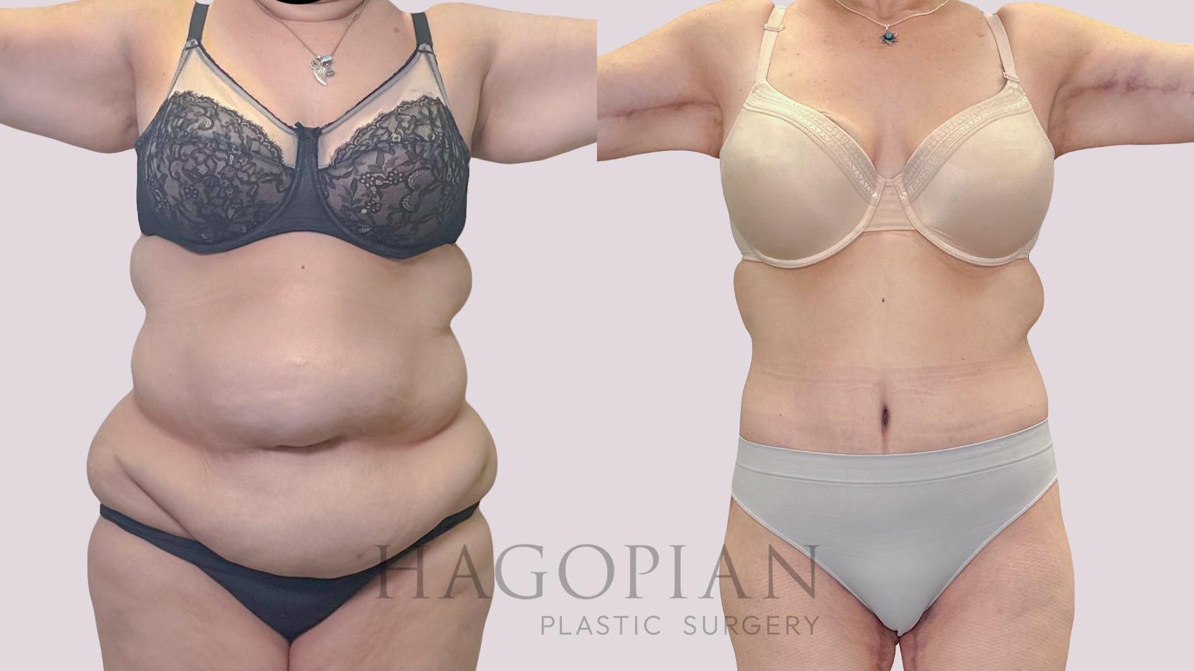 Before & After Drainless Tummy Tuck Case 301 Front View in Atlanta, GA