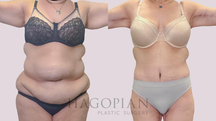 Before & After Drainless Tummy Tuck Case 301 Front View in Atlanta, GA