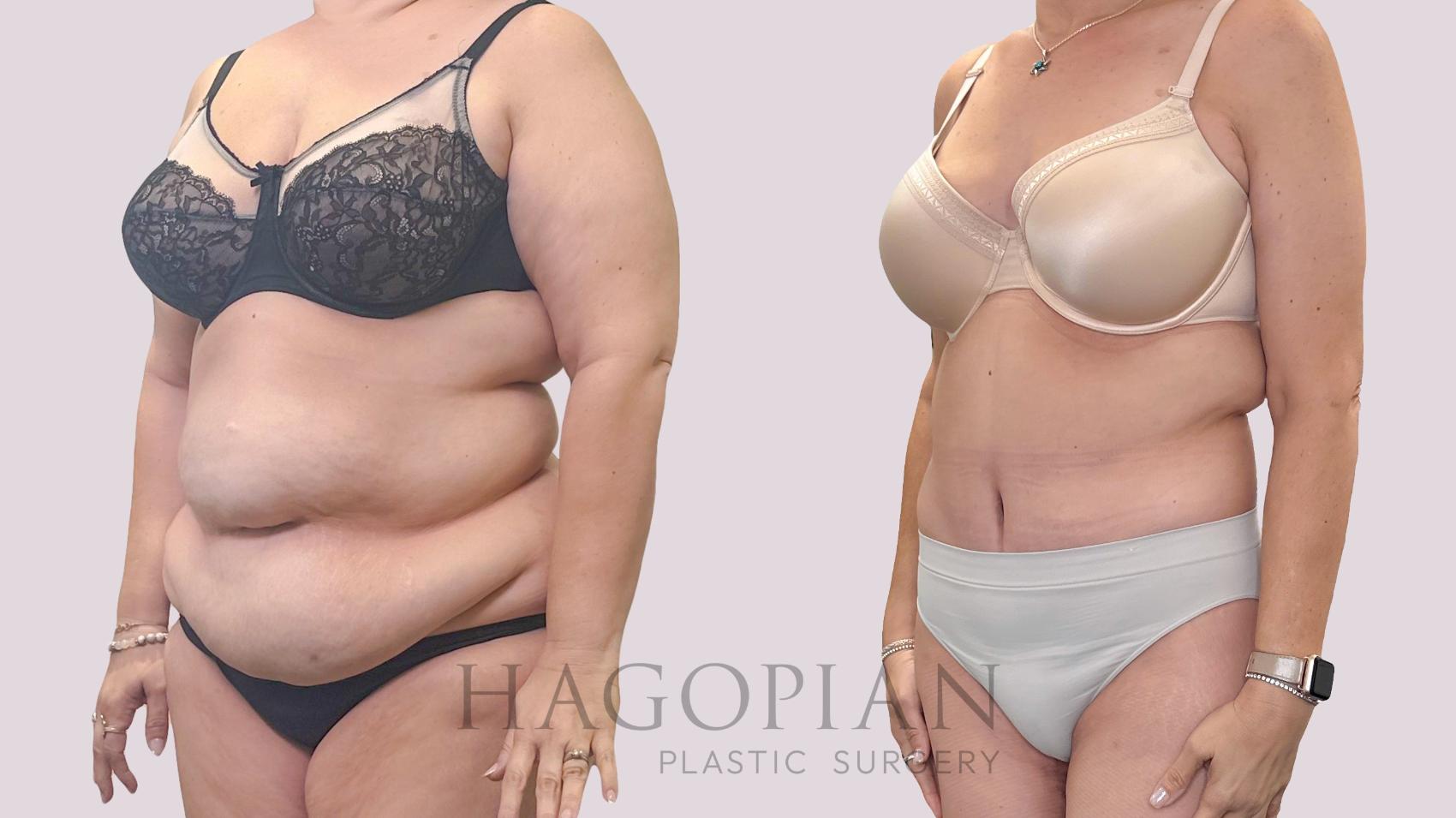 Before & After Drainless Tummy Tuck Case 301 Left Oblique View in Atlanta, GA