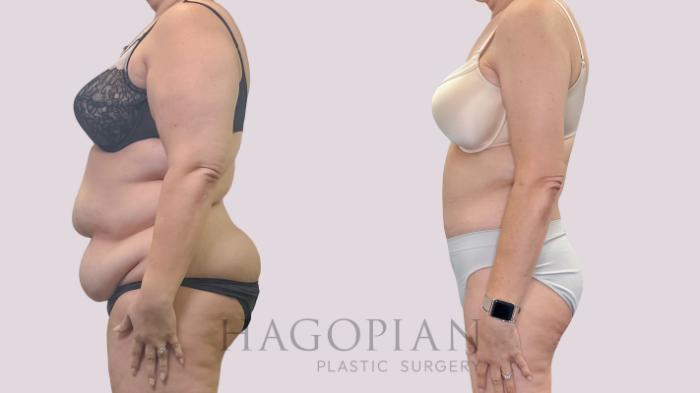 Before & After Drainless Tummy Tuck Case 301 Left Side View in Atlanta, GA