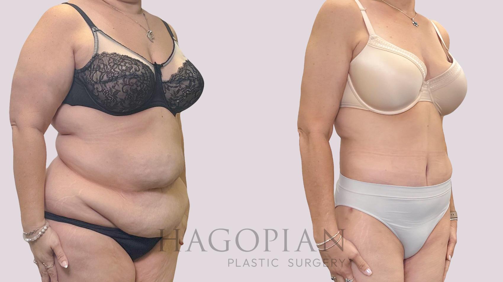 Before & After Drainless Tummy Tuck Case 301 Right Oblique View in Atlanta, GA
