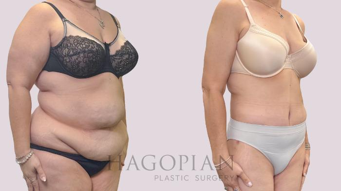 Before & After Drainless Tummy Tuck Case 301 Right Oblique View in Atlanta, GA