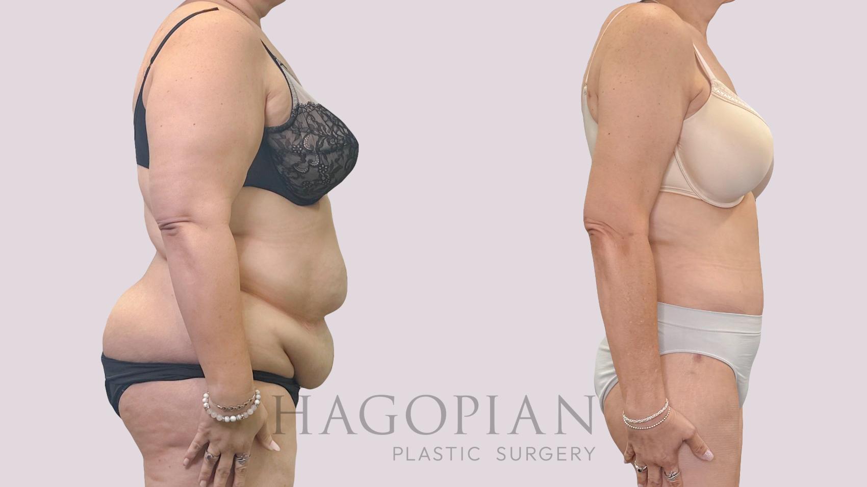 Before & After Drainless Tummy Tuck Case 301 Right Side View in Atlanta, GA