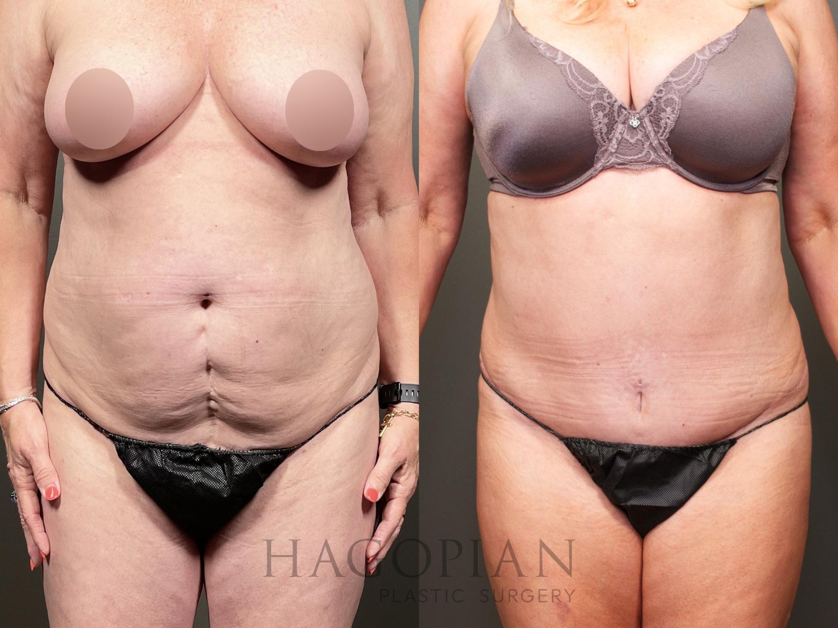 Before & After Drainless Tummy Tuck Case 34 Front View in Atlanta, GA