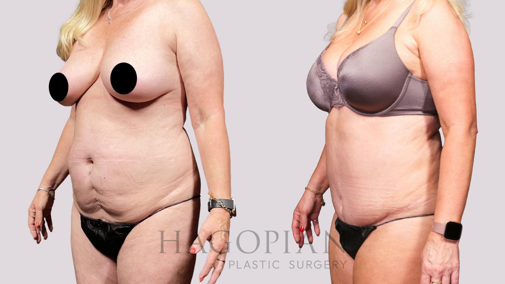 Before & After Drainless Tummy Tuck Case 34 Left Oblique View in Atlanta, GA