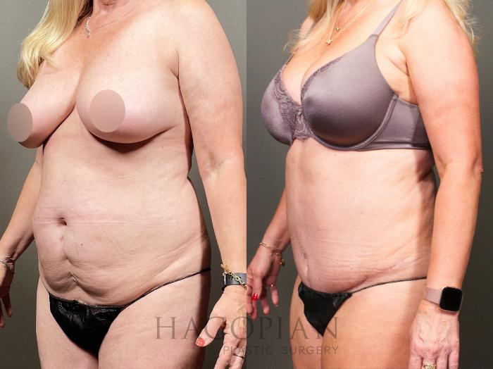 Before & After Drainless Tummy Tuck Case 34 Left Oblique View in Atlanta, GA