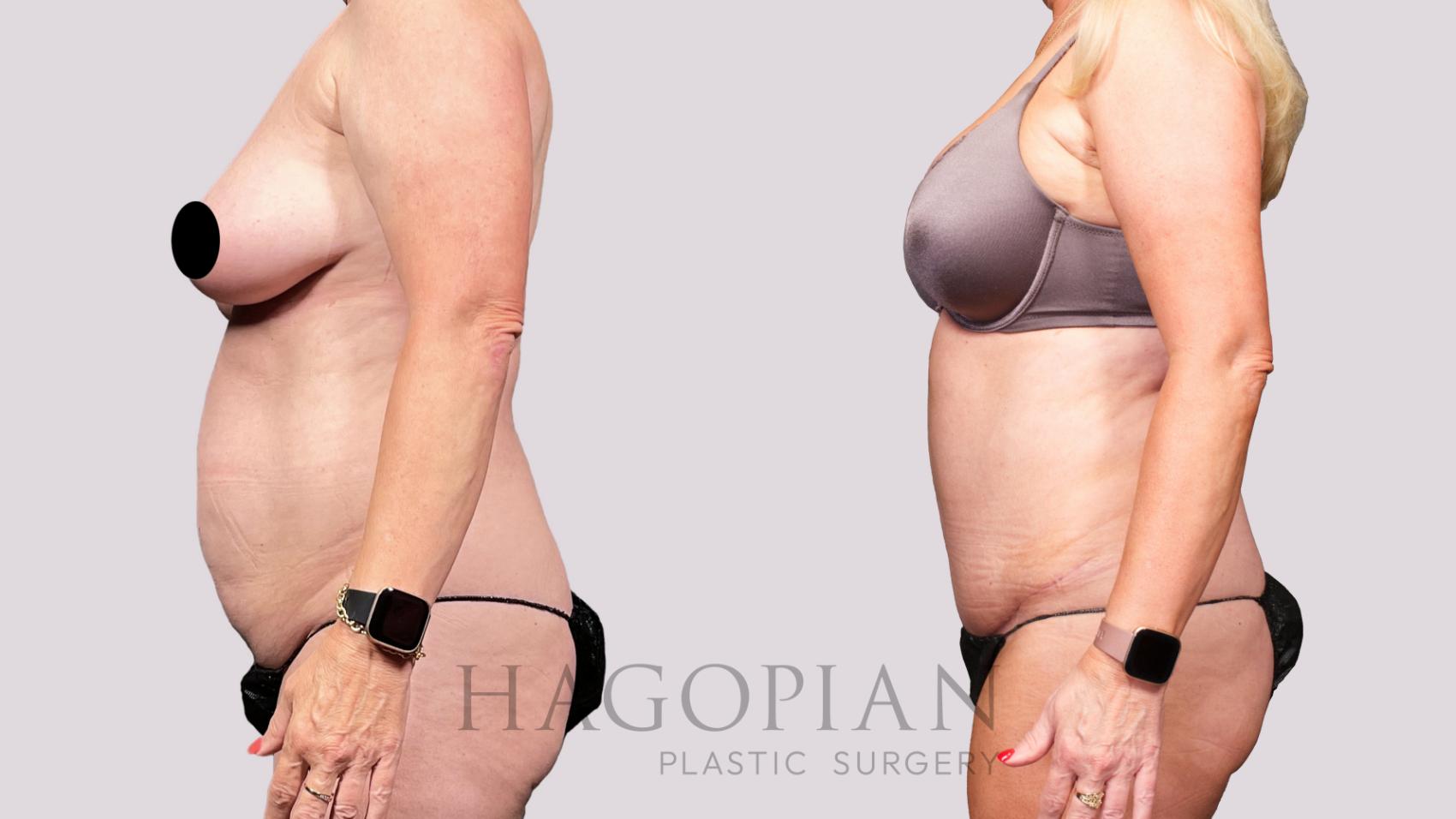 Before & After Drainless Tummy Tuck Case 34 Left Side View in Atlanta, GA