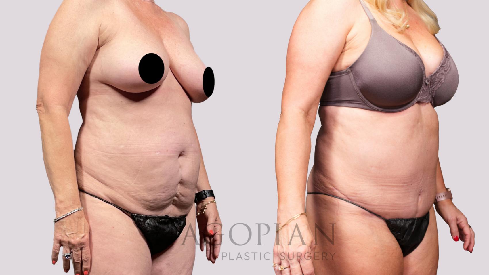 Before & After Drainless Tummy Tuck Case 34 Right Oblique View in Atlanta, GA