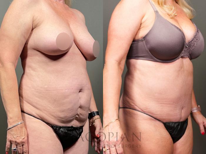 Before & After Drainless Tummy Tuck Case 34 Right Oblique View in Atlanta, GA
