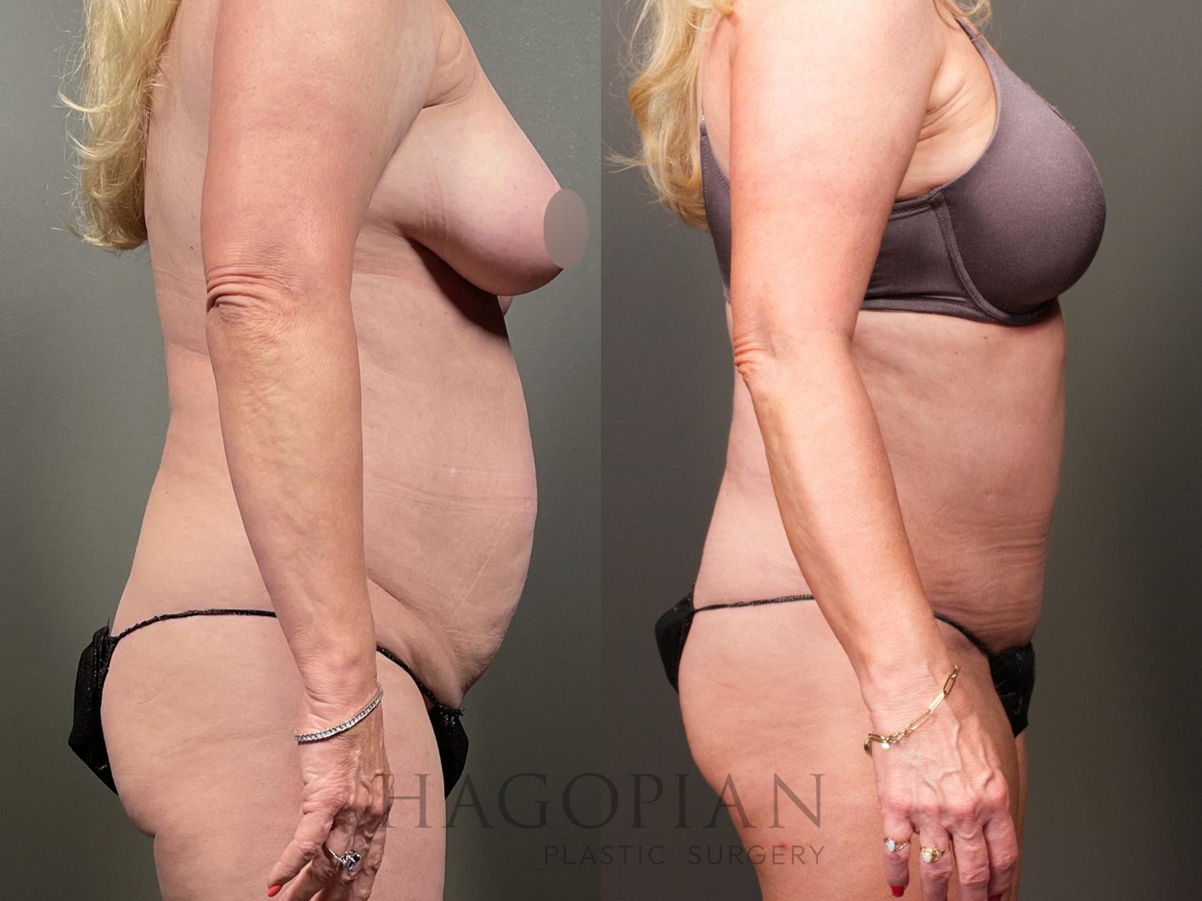Before & After Drainless Tummy Tuck Case 34 Right Side View in Atlanta, GA