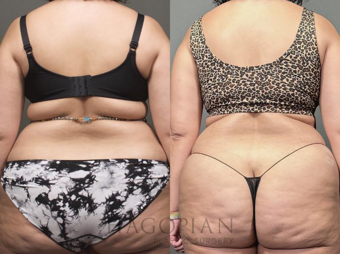 Before & After Drainless Tummy Tuck Case 53 Back View in Atlanta, GA