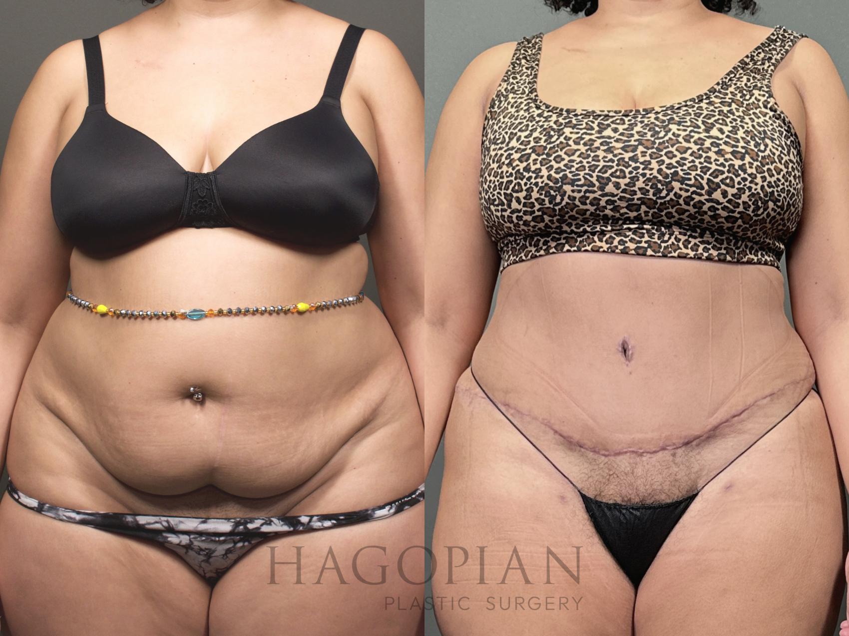 Before & After Drainless Tummy Tuck Case 53 Front View in Atlanta, GA