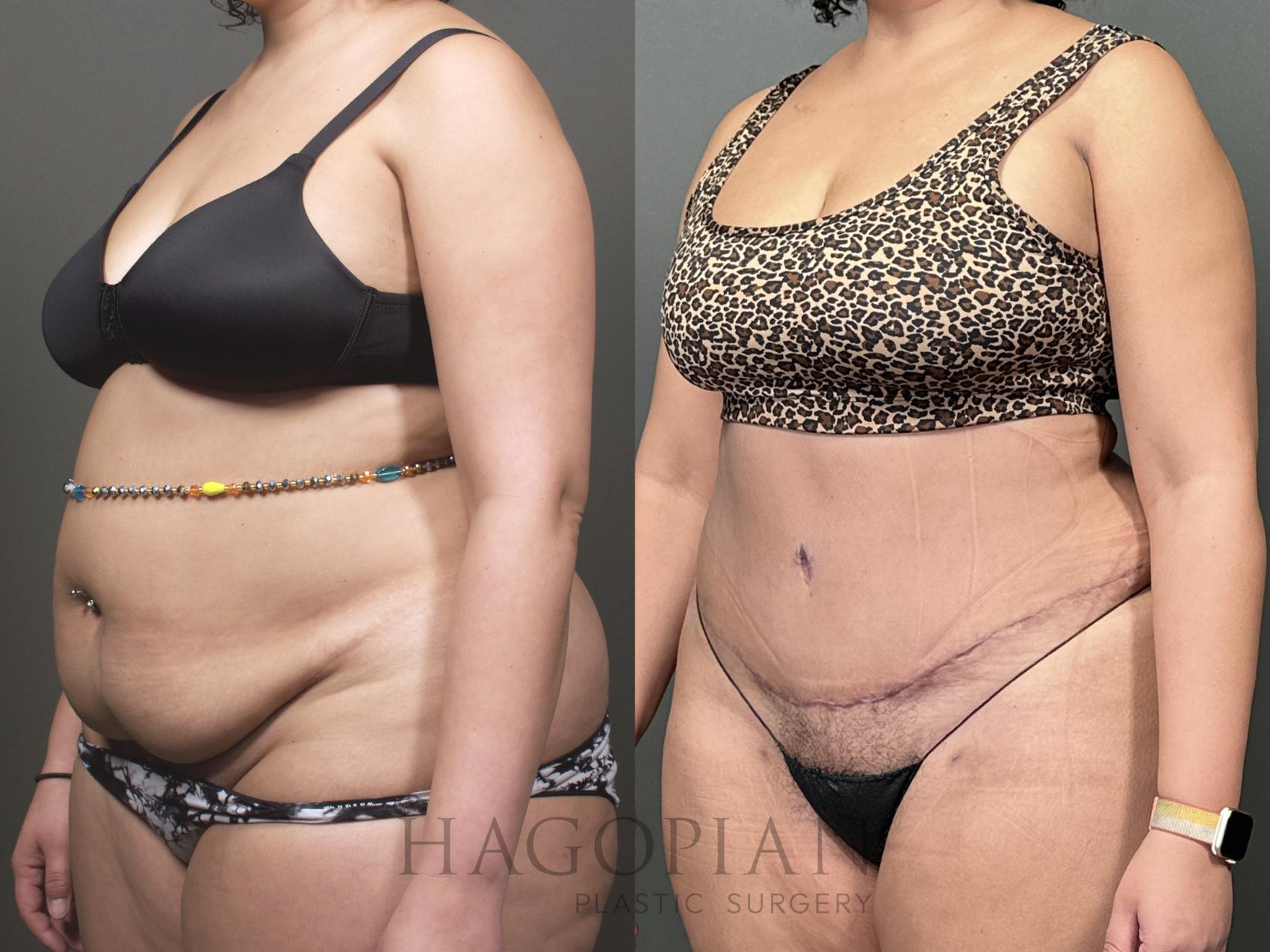 Before & After Drainless Tummy Tuck Case 53 Left Oblique View in Atlanta, GA