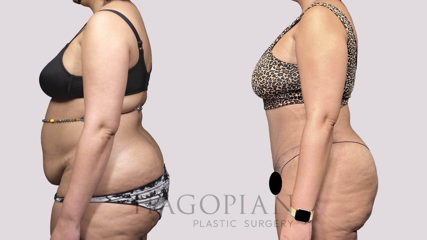Before & After Drainless Tummy Tuck Case 53 Left Side View in Atlanta, GA