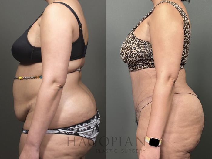 Before & After Drainless Tummy Tuck Case 53 Left Side View in Atlanta, GA