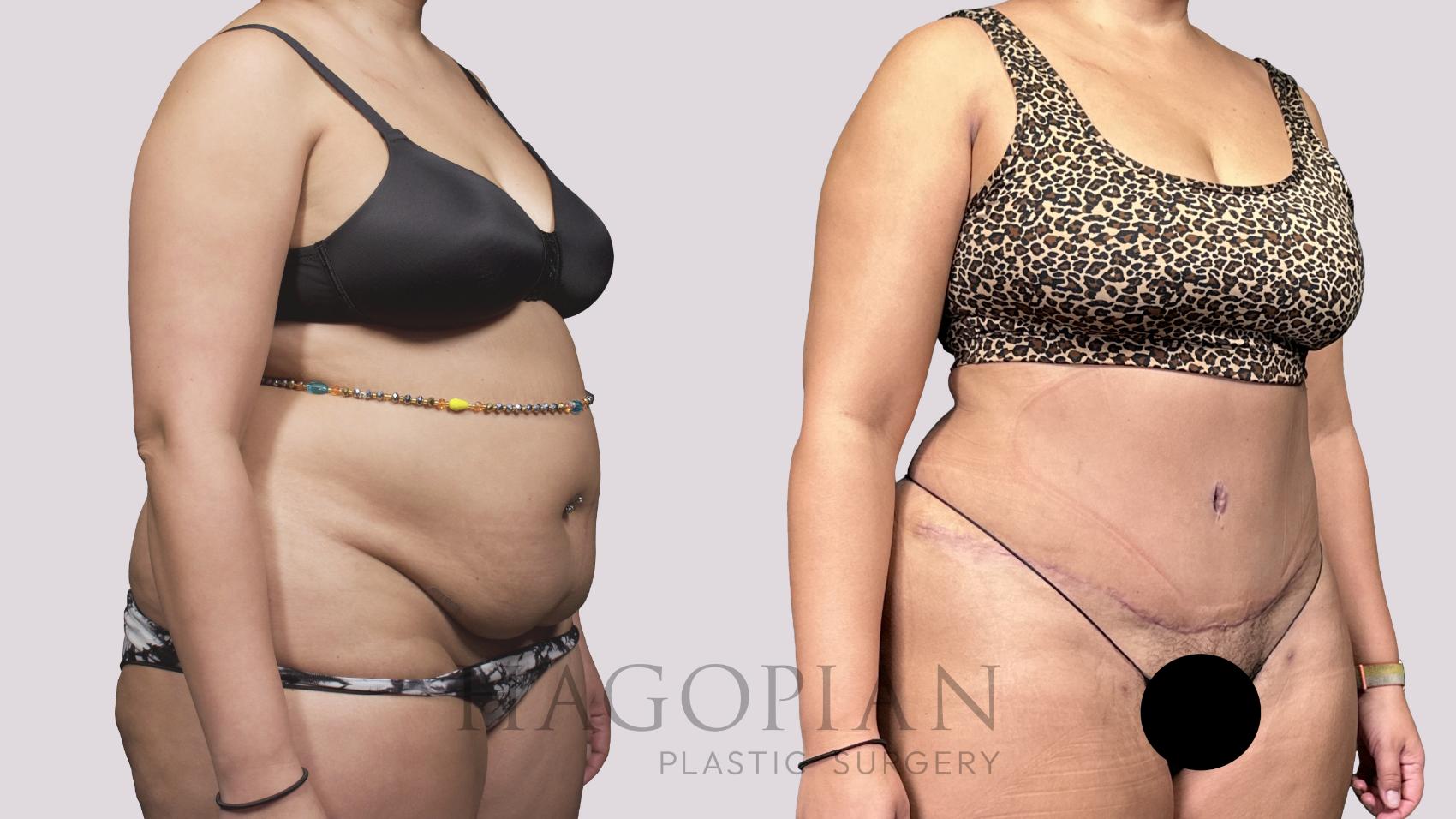 Before & After Drainless Tummy Tuck Case 53 Right Oblique View in Atlanta, GA