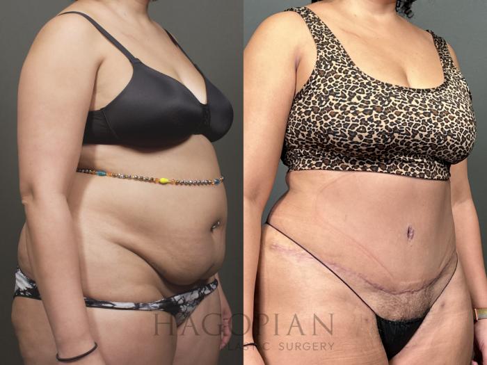Before & After Drainless Tummy Tuck Case 53 Right Oblique View in Atlanta, GA