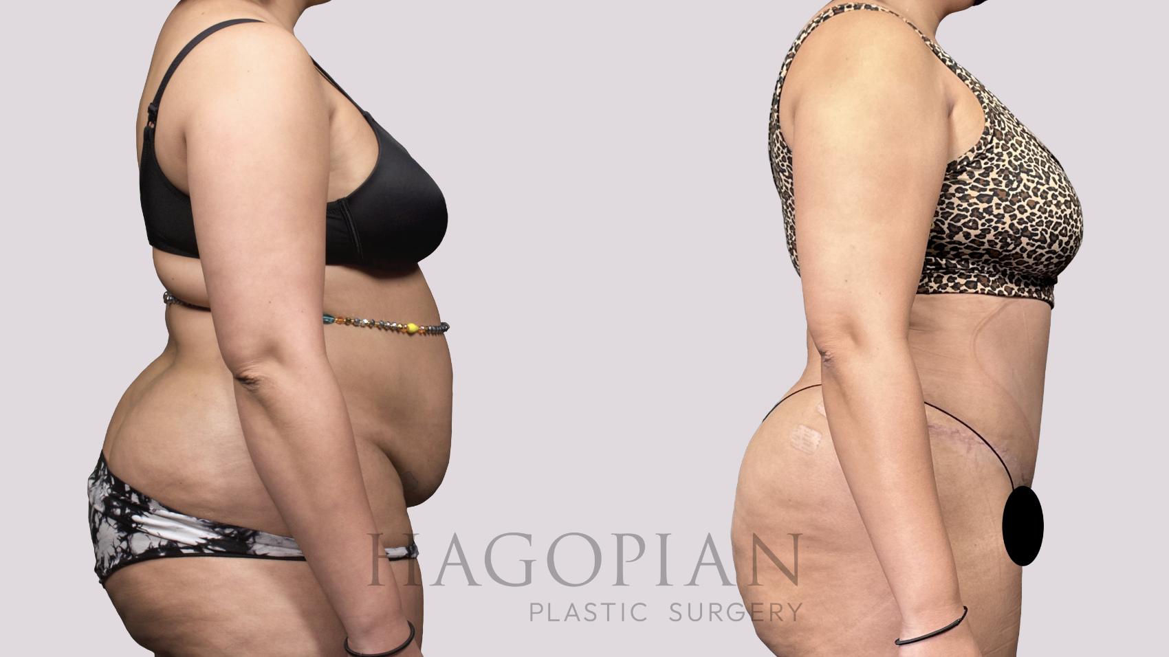 Before & After Drainless Tummy Tuck Case 53 Right Side View in Atlanta, GA