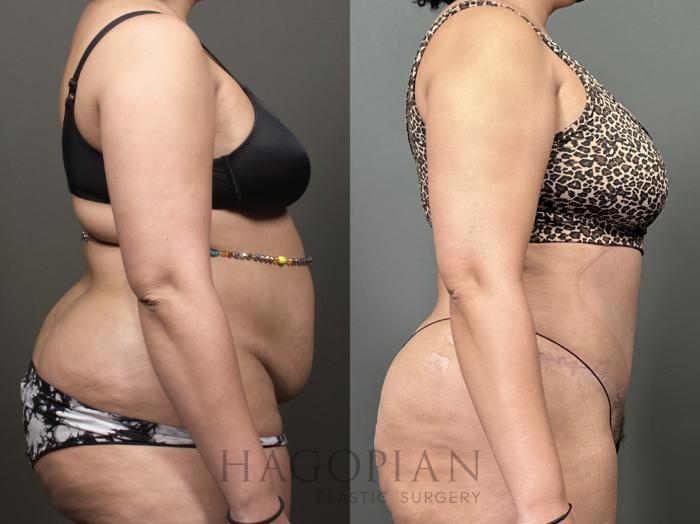 Before & After Drainless Tummy Tuck Case 53 Right Side View in Atlanta, GA