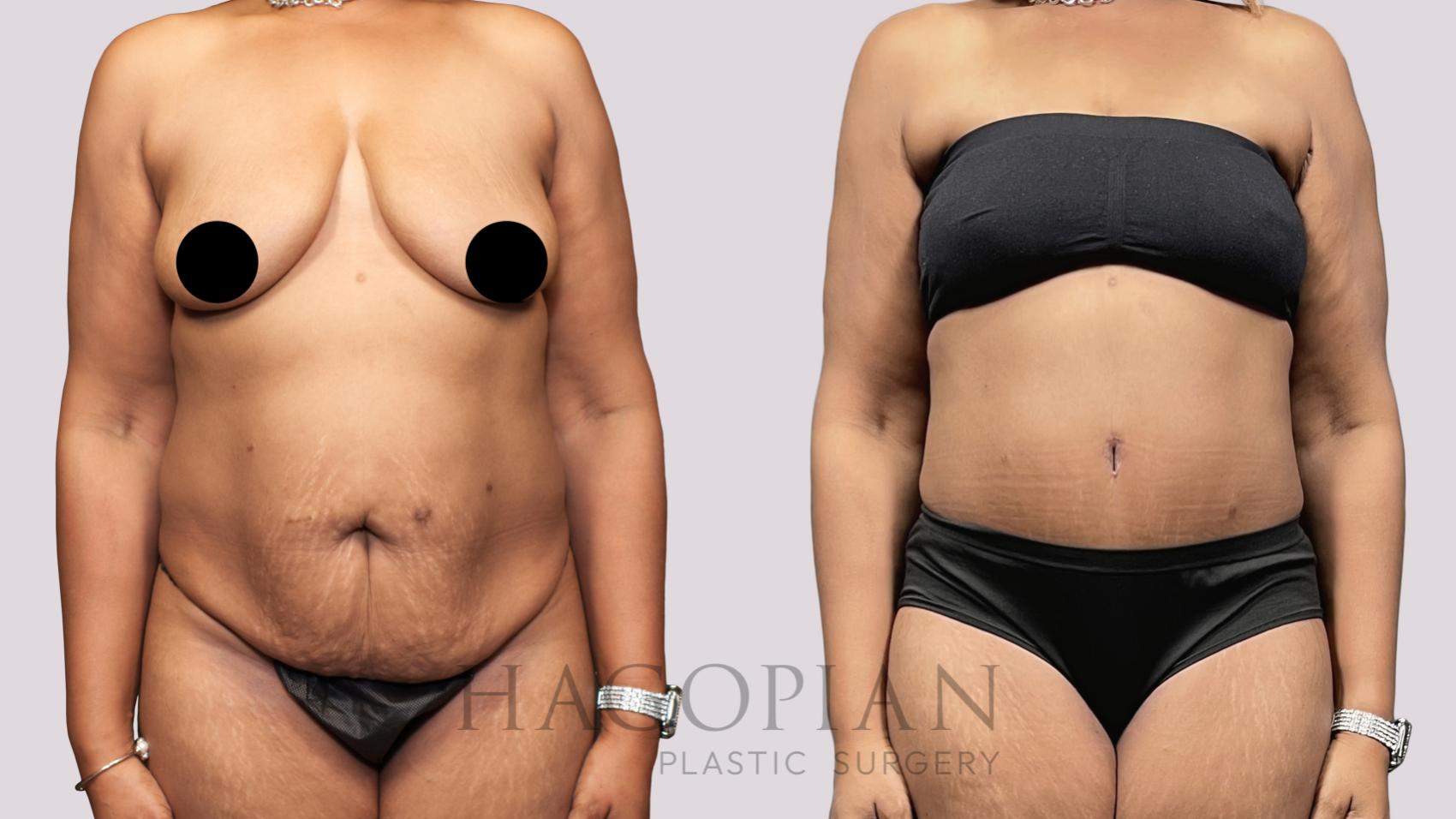 Before & After Drainless Tummy Tuck Case 65 Front View in Atlanta, GA