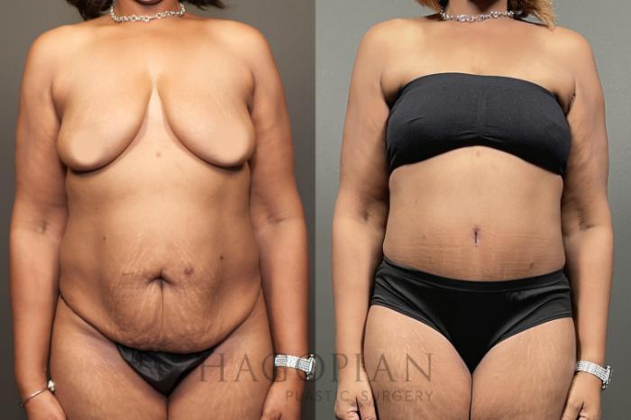Before & After Drainless Tummy Tuck Case 65 Front View in Atlanta, GA