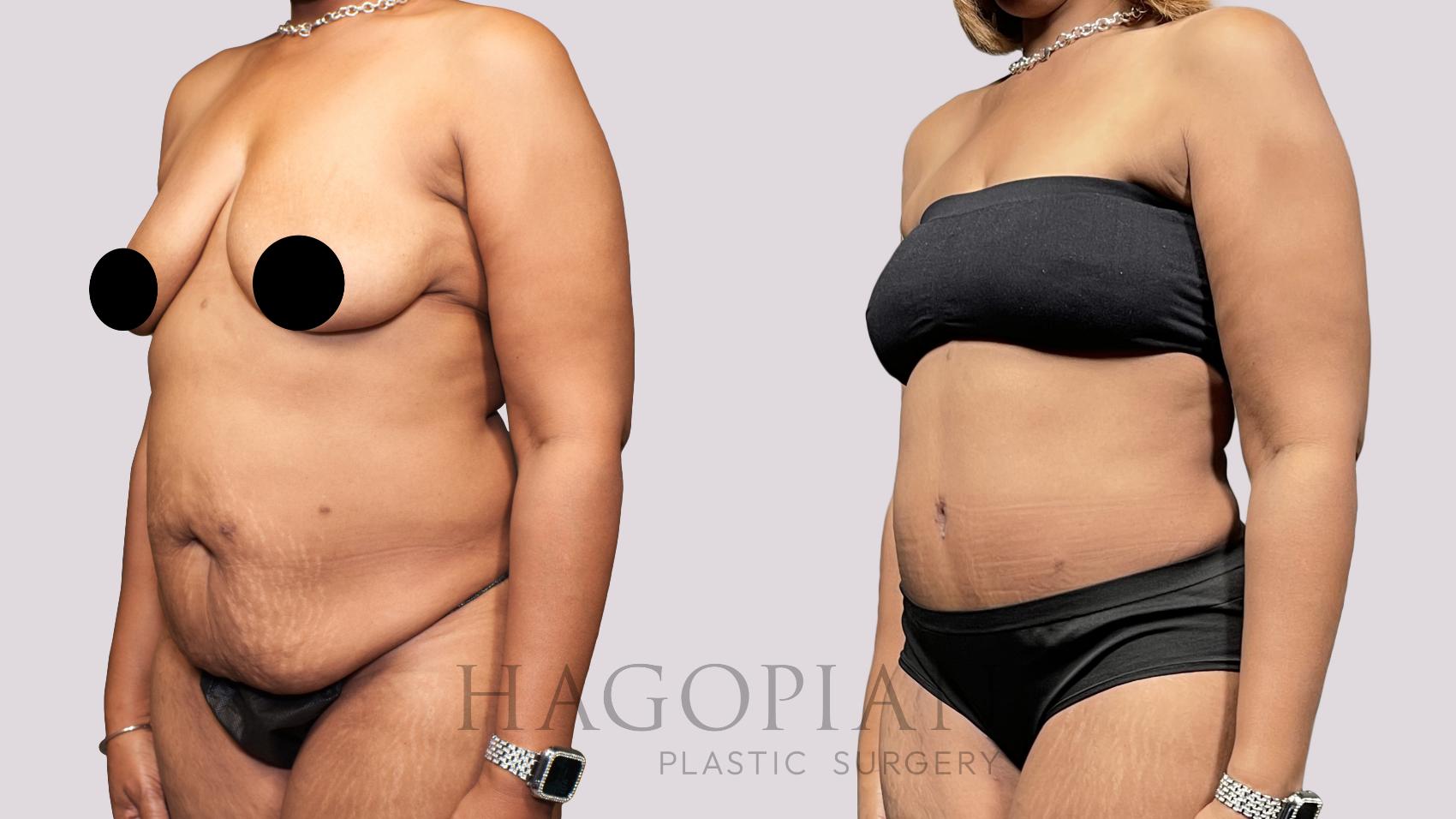 Before & After Drainless Tummy Tuck Case 65 Left Oblique View in Atlanta, GA