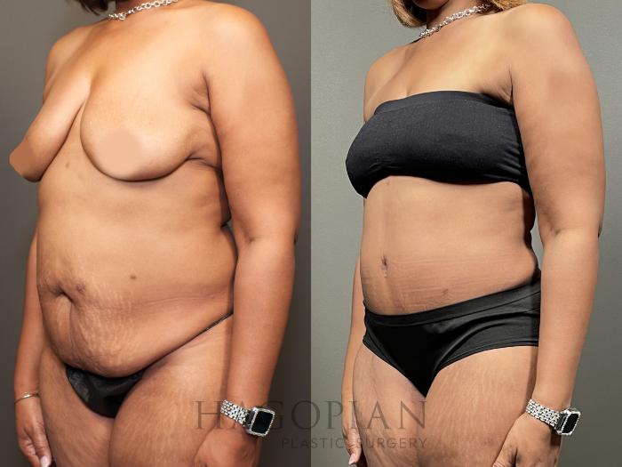 Before & After Drainless Tummy Tuck Case 65 Left Oblique View in Atlanta, GA