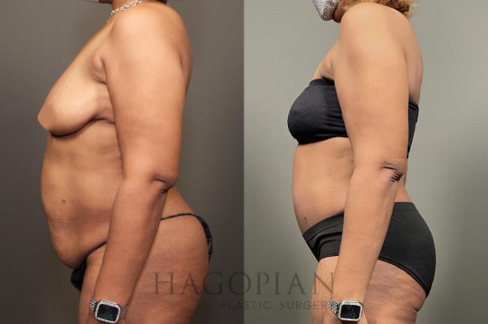 Before & After Drainless Tummy Tuck Case 65 Left Side View in Atlanta, GA