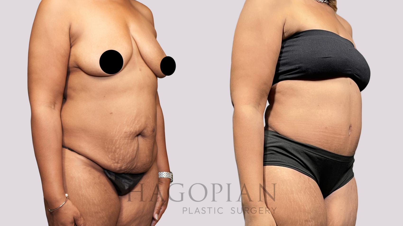 Before & After Drainless Tummy Tuck Case 65 Right Oblique View in Atlanta, GA