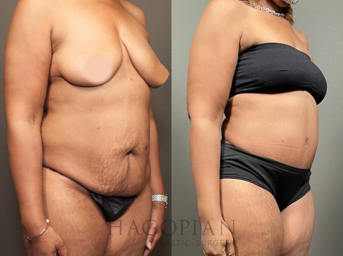 Before & After Drainless Tummy Tuck Case 65 Right Oblique View in Atlanta, GA