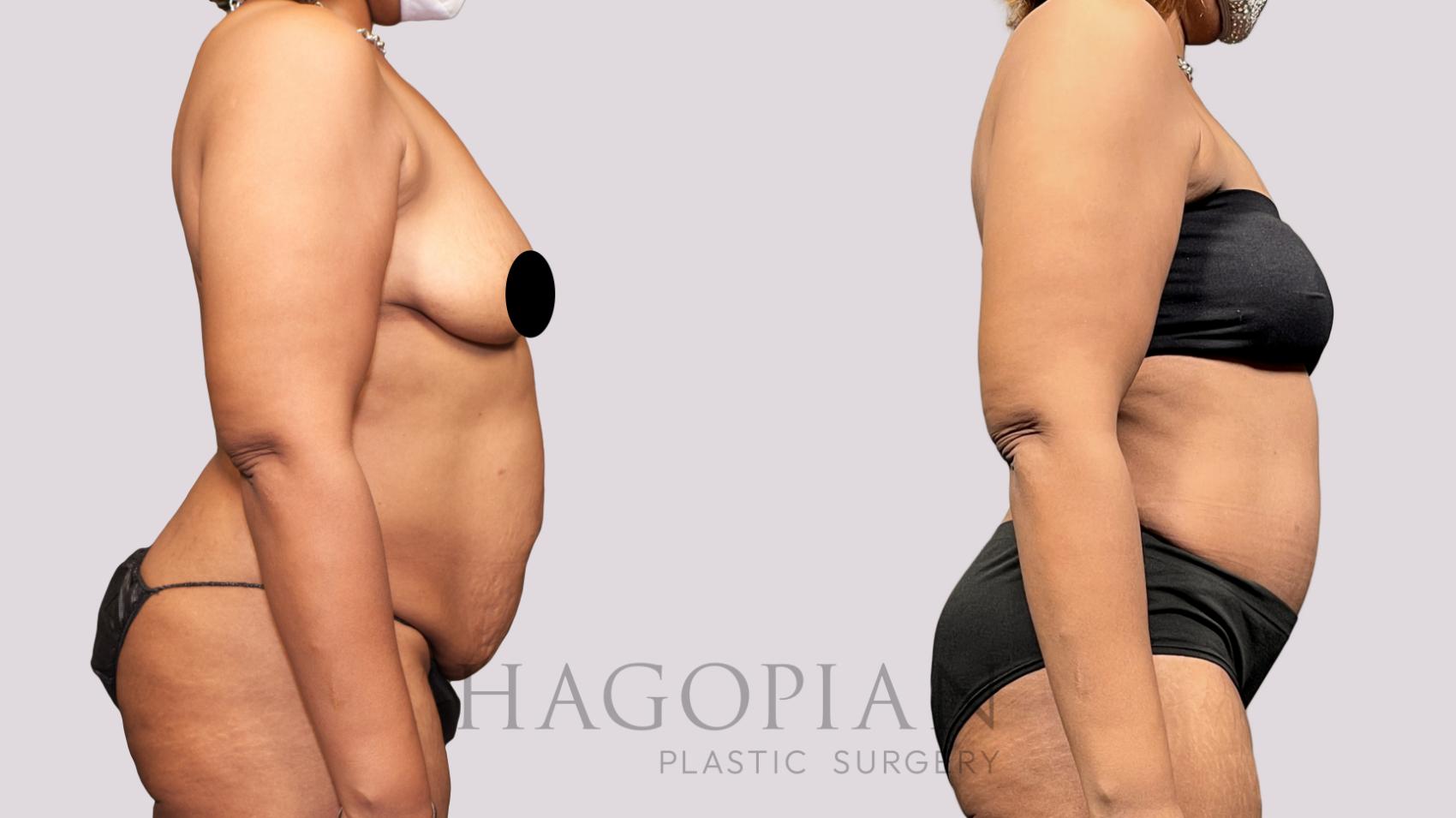 Before & After Drainless Tummy Tuck Case 65 Right Side View in Atlanta, GA