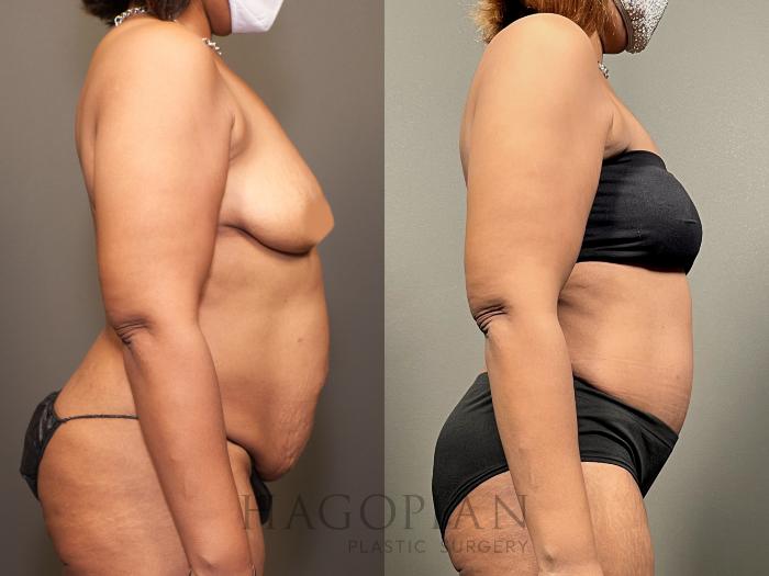 Before & After Drainless Tummy Tuck Case 65 Right Side View in Atlanta, GA
