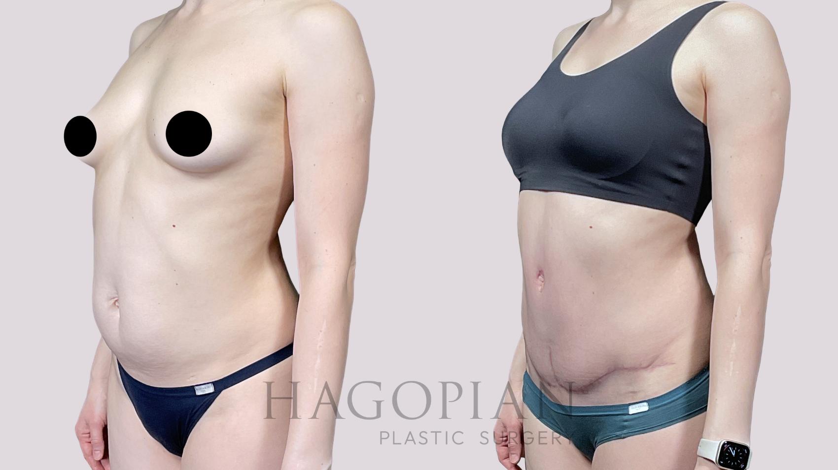 Before & After Drainless Tummy Tuck Case 66 Left Oblique View in Atlanta, GA