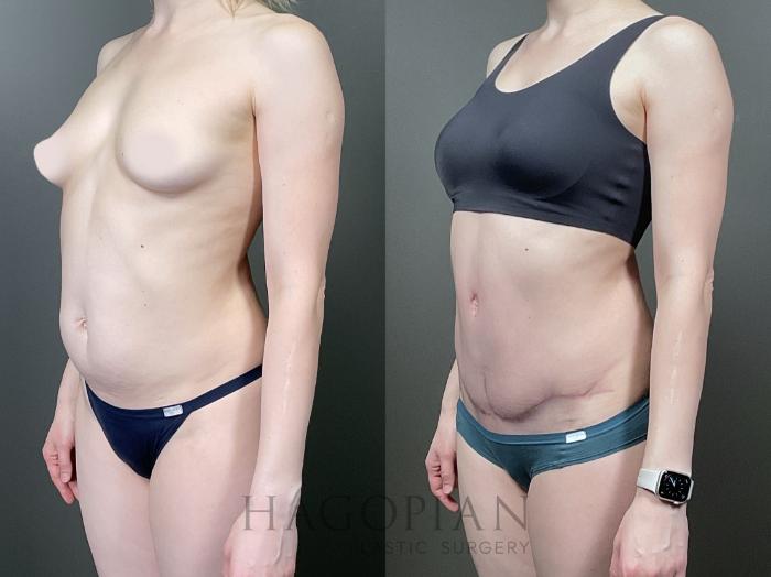 Before & After Drainless Tummy Tuck Case 66 Left Oblique View in Atlanta, GA