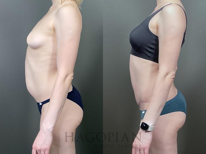 Before & After Drainless Tummy Tuck Case 66 Left Side View in Atlanta, GA