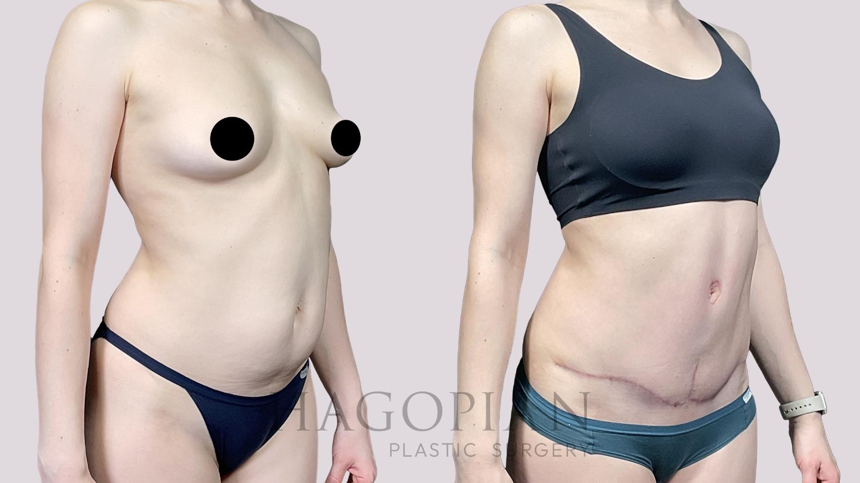 Before & After Drainless Tummy Tuck Case 66 Right Oblique View in Atlanta, GA