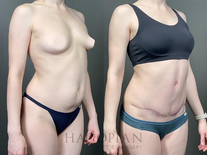 Before & After Drainless Tummy Tuck Case 66 Right Oblique View in Atlanta, GA