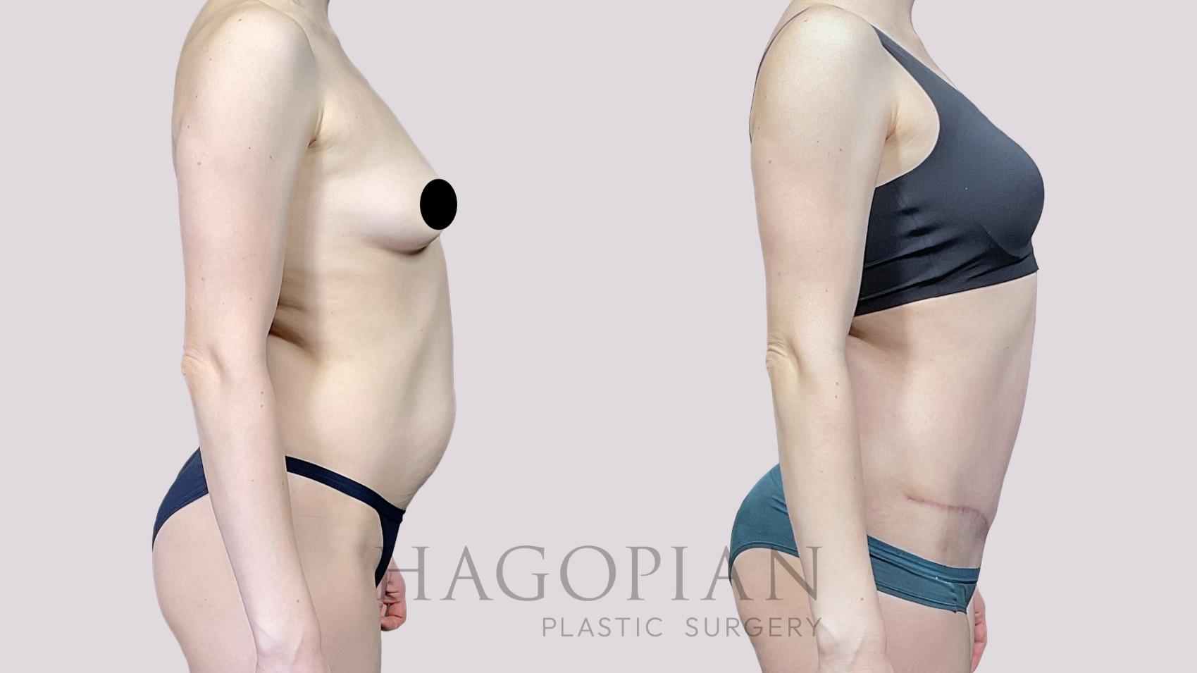 Before & After Drainless Tummy Tuck Case 66 Right Side View in Atlanta, GA