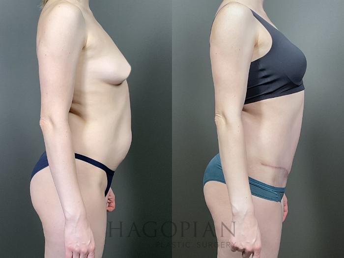 Before & After Drainless Tummy Tuck Case 66 Right Side View in Atlanta, GA