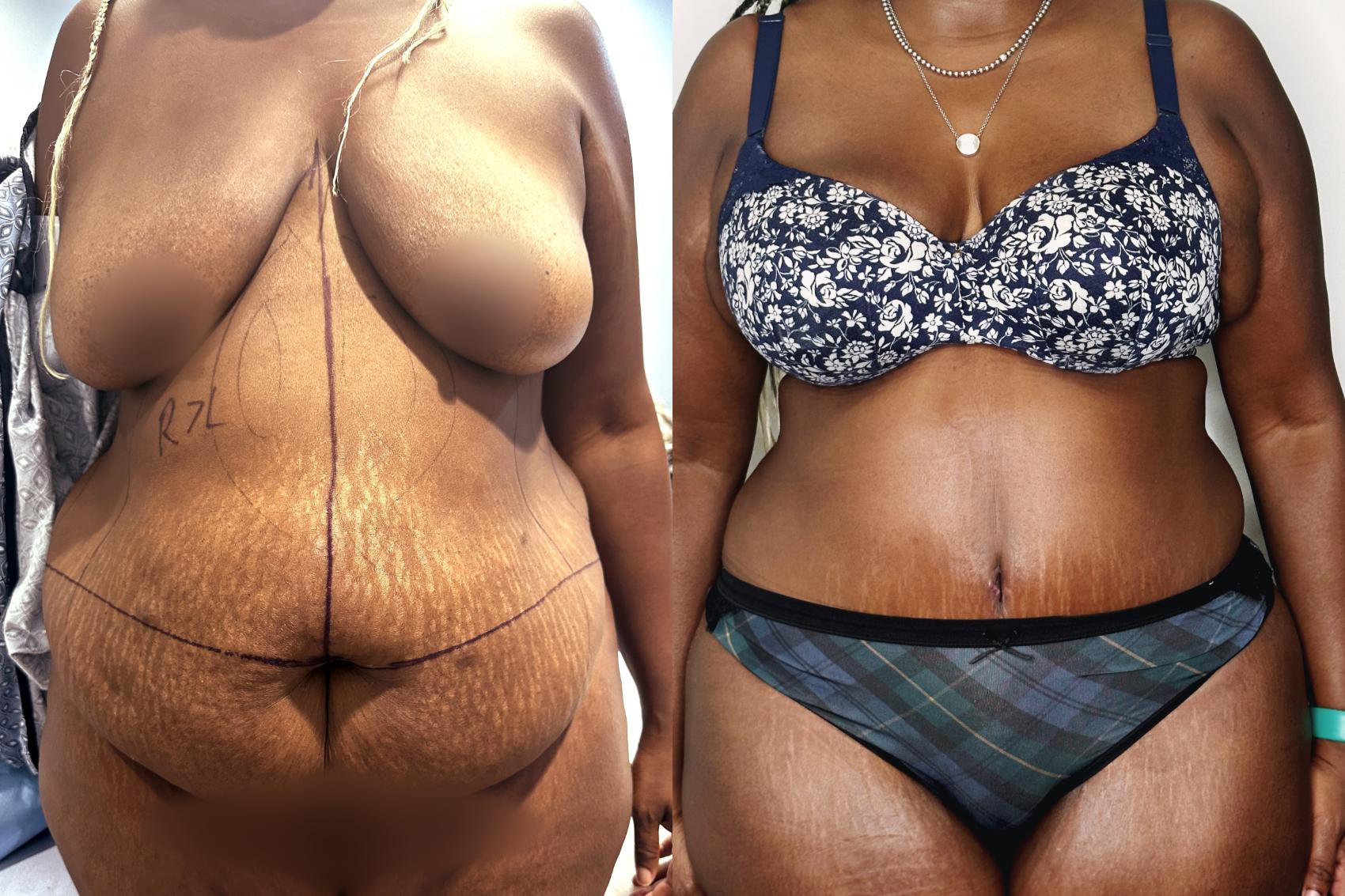 Before & After Drainless Tummy Tuck Case 75 Front View in Atlanta, GA