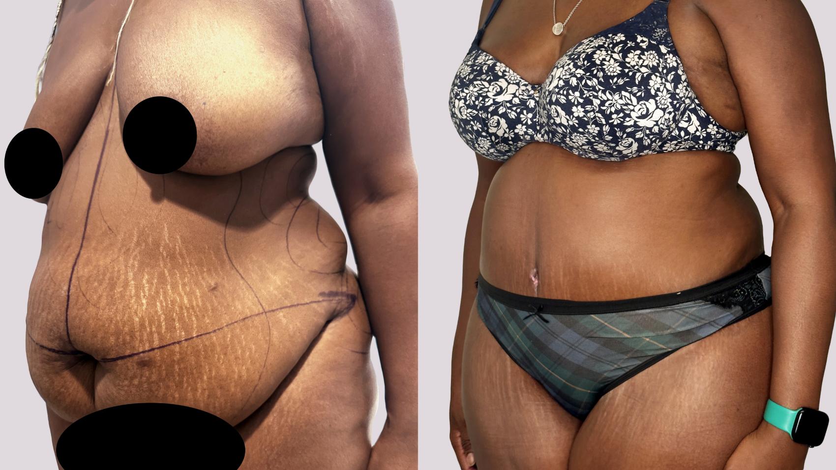 Before & After Drainless Tummy Tuck Case 75 Left Oblique View in Atlanta, GA