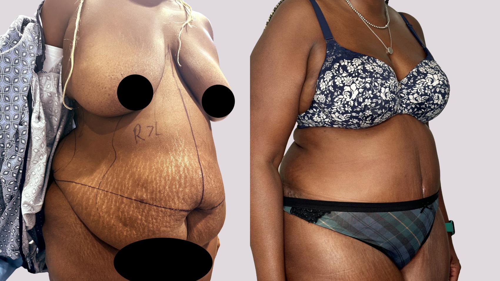Before & After Drainless Tummy Tuck Case 75 Right Oblique View in Atlanta, GA