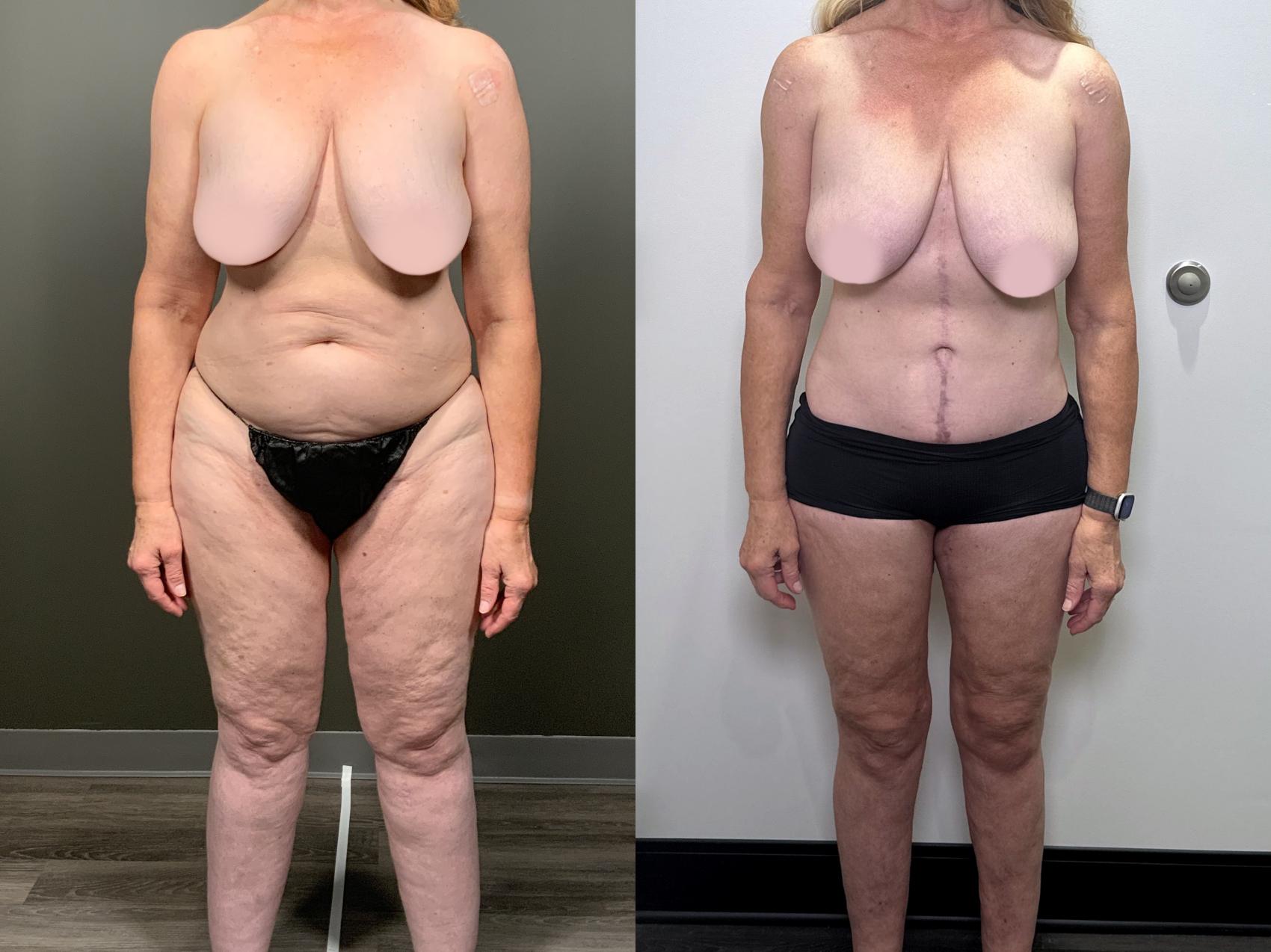 Before & After Drainless Tummy Tuck Case 87 Front View in Atlanta, GA